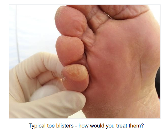 ampollas tipicas en los dedos de los pies