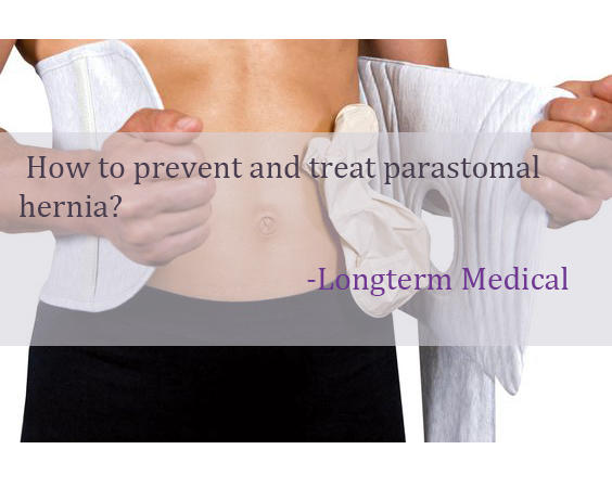 ¿Cómo prevenir y tratar la hernia paraestomal?