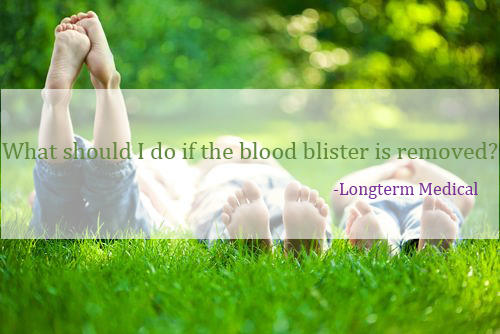 ¿Qué debo hacer si tengo ampollas de sangre en los pies?