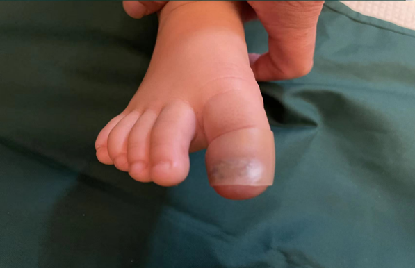 Uñas de los pies lesionadas en niños