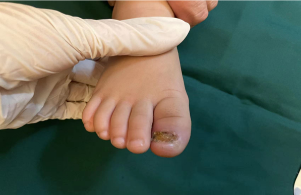 Uñas de los pies lesionadas en niños