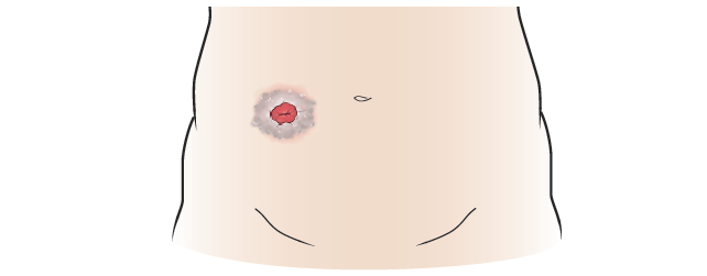 Infección del estoma