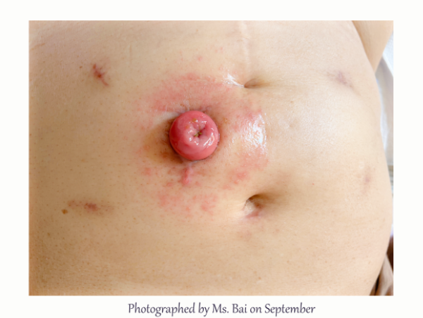 Dermatitis por agua fecal